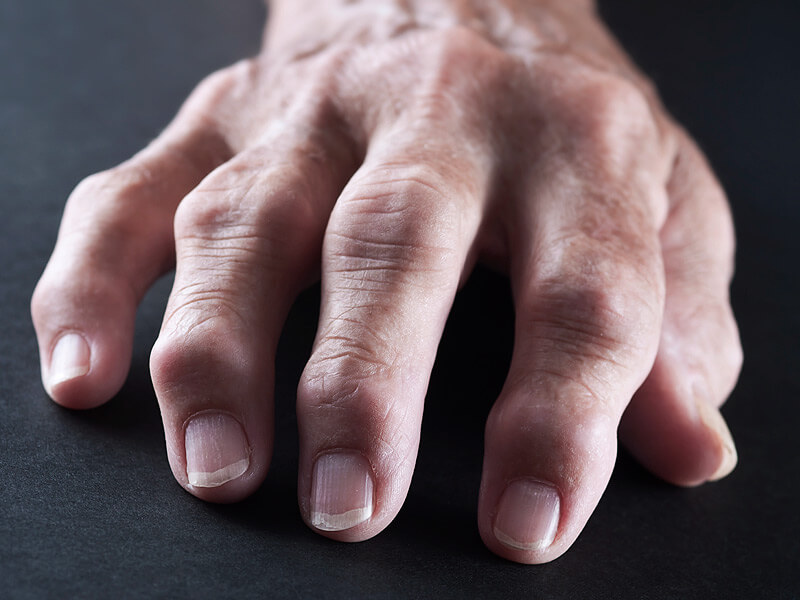 noduláris osteoarthritis a csípőízület fáj a lábán